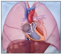 Pulmonary valve disease
