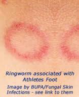 does lamisil treat ringworm