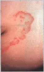 ringworm body