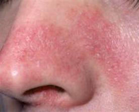 Image result for seborrheic dermatitis