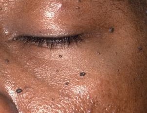 facial seborrheic keratosis Facial seborrheic keratosis