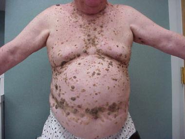 seborrheic keratosis india pdf ppt case reports symptoms