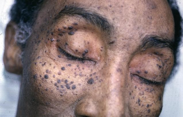 seborrheic keratosis india pdf ppt case reports symptoms