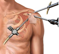 shoulder symptom modification procedure pdf