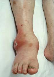 septic arthritis