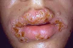 picture of sexual transmitted disease Verrucous ca of vulva