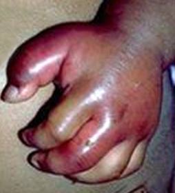 the signs and symptoms of sickle cell anaemia Episodes of pain - known as sickle cell crises - are one of the most common warning signs, they occur when a blood vessel becomes blocked due to the abnormal shape of the red blood cells. the signs and symptoms of sickle cell anaemia Episodes of pain - known as sickle cell crises - are one of the most common warning signs, they occur when a blood vessel becomes blocked due to the abnormal shape of the red blood cells.