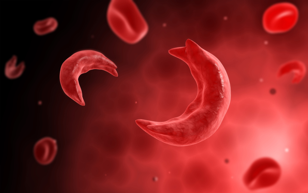 Sickle Cell Disease