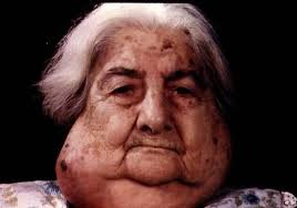  Sjogrens syndrome France PDF PPT Case Reports 