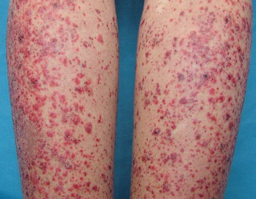 Sjogrens syndrome | Poland| PDF | PPT| Case Reports | Symptoms | Treatment