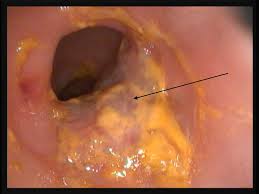 What Symptoms Of Bowel Cancer : Ten Cancer Warning Signs Men Ignore: Nos 6 - 10 - mid life ... : Bowel cancer is one of the most common cancers in the uk for over 60's.