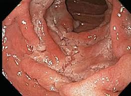 Small bowel prolapse