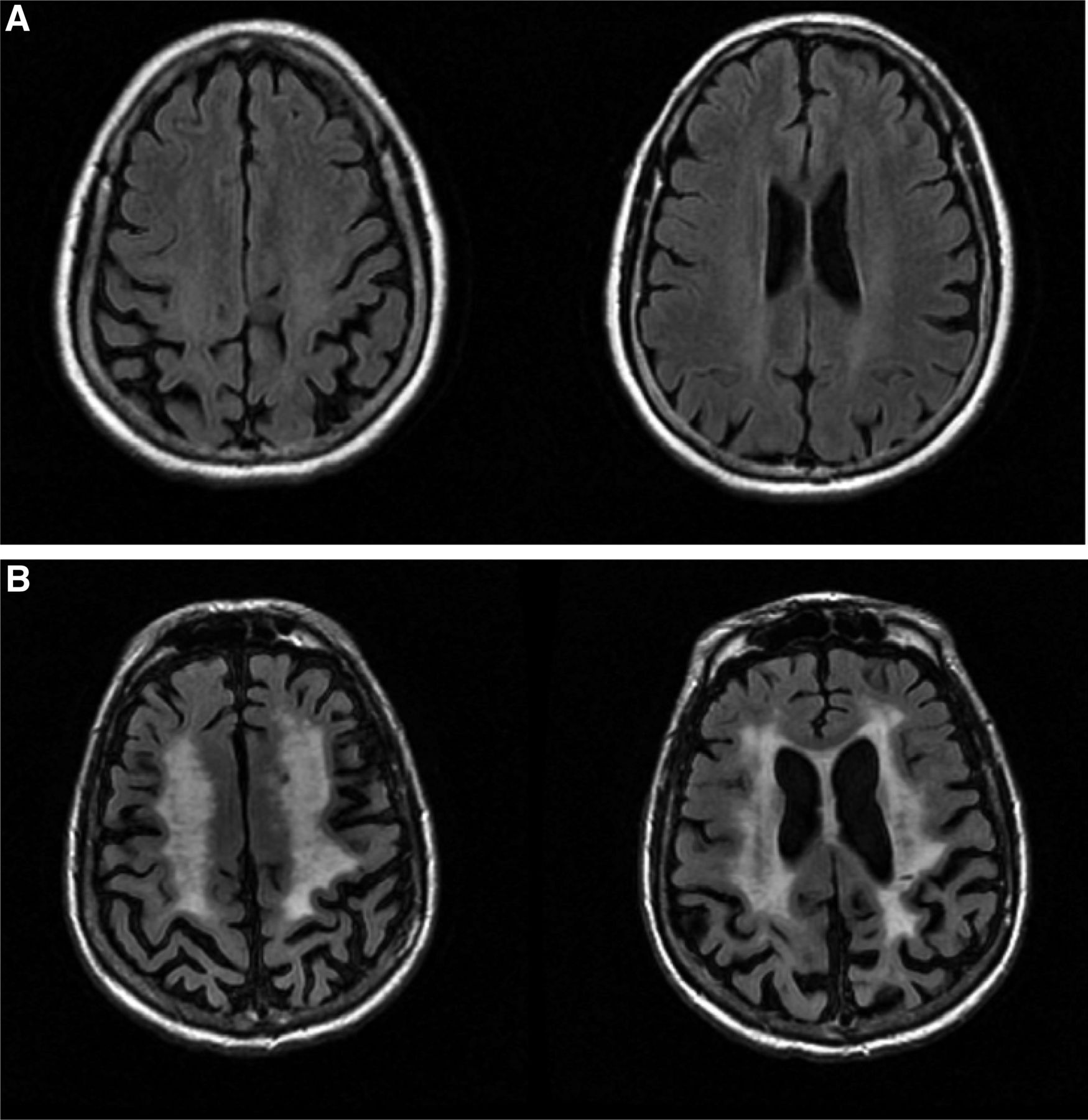 Small vessel disease