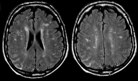 Small vessel disease