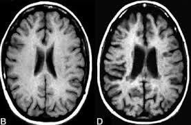 Small vessel disease