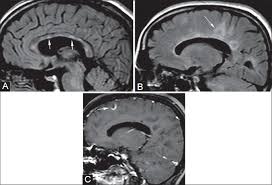 Small vessel disease