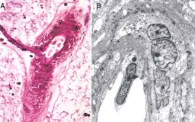 Small vessel disease