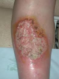 Small vessel disease