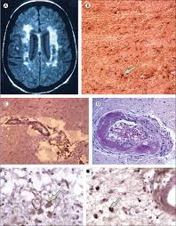 Small vessel disease