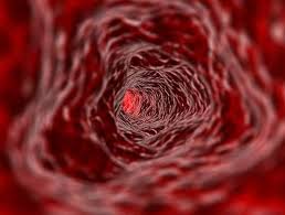 Small vessel disease