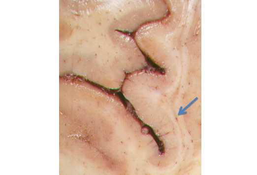 Small vessel disease