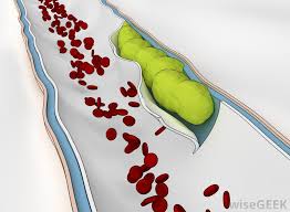 Small vessel disease