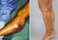 Soft Tissue Sarcoma | India| PDF | PPT| Case Reports | Symptoms | Treatment
