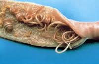 Helminths helminthiases