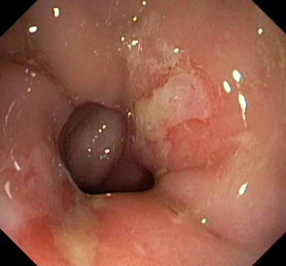 Solitary rectal ulcer syndrome