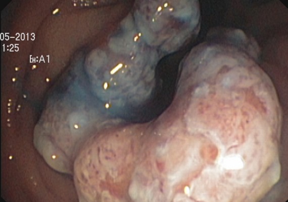 anus tumor near Symptoms of