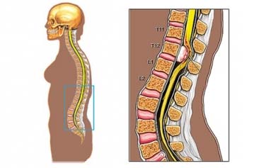 Spinal cord tumor | Spain| PDF | PPT| Case Reports | Symptoms | Treatment