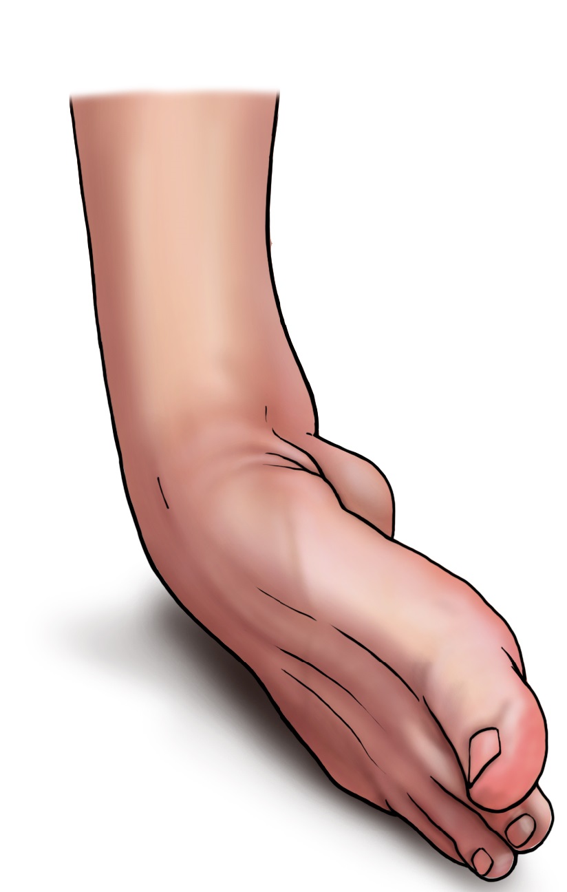 sprained ankle australia pdf