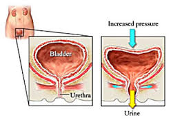 incontinence stress