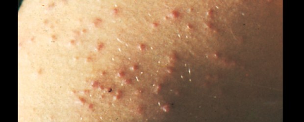 infected swimmers itch infected swimmers itch