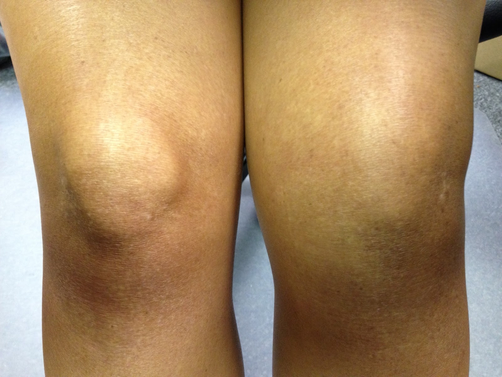 Swollen knee