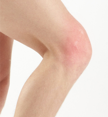 Swollen knee | Mexico| PDF | PPT| Case Reports | Symptoms | Treatment
