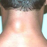 lymph nodes on back of neck swollen
