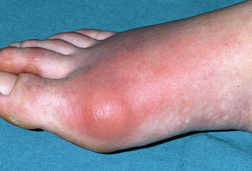 Systemic capillary leak syndrome Systemic capillary leak syndrome
