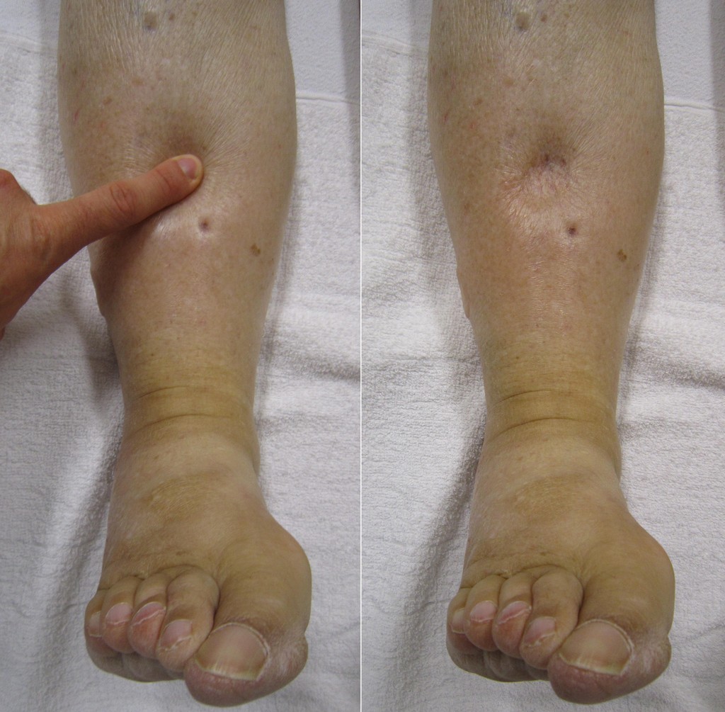 Systemic capillary leak syndrome | Ireland| PDF | PPT| Case Reports |  Symptoms | Treatment