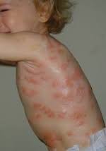 Systemic Mastocytosis Natural Treatment Systemic Mastocytosis Natural Treatment
