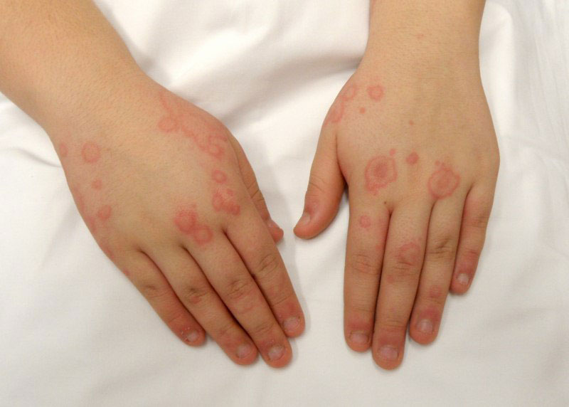 primary immunodeficiency diseases definition diagnosis and management pdf
