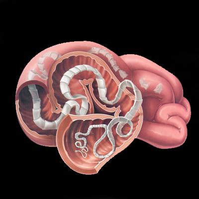 Human tapeworm infection