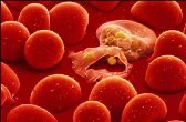 thalassemia minor thalassemia minor
