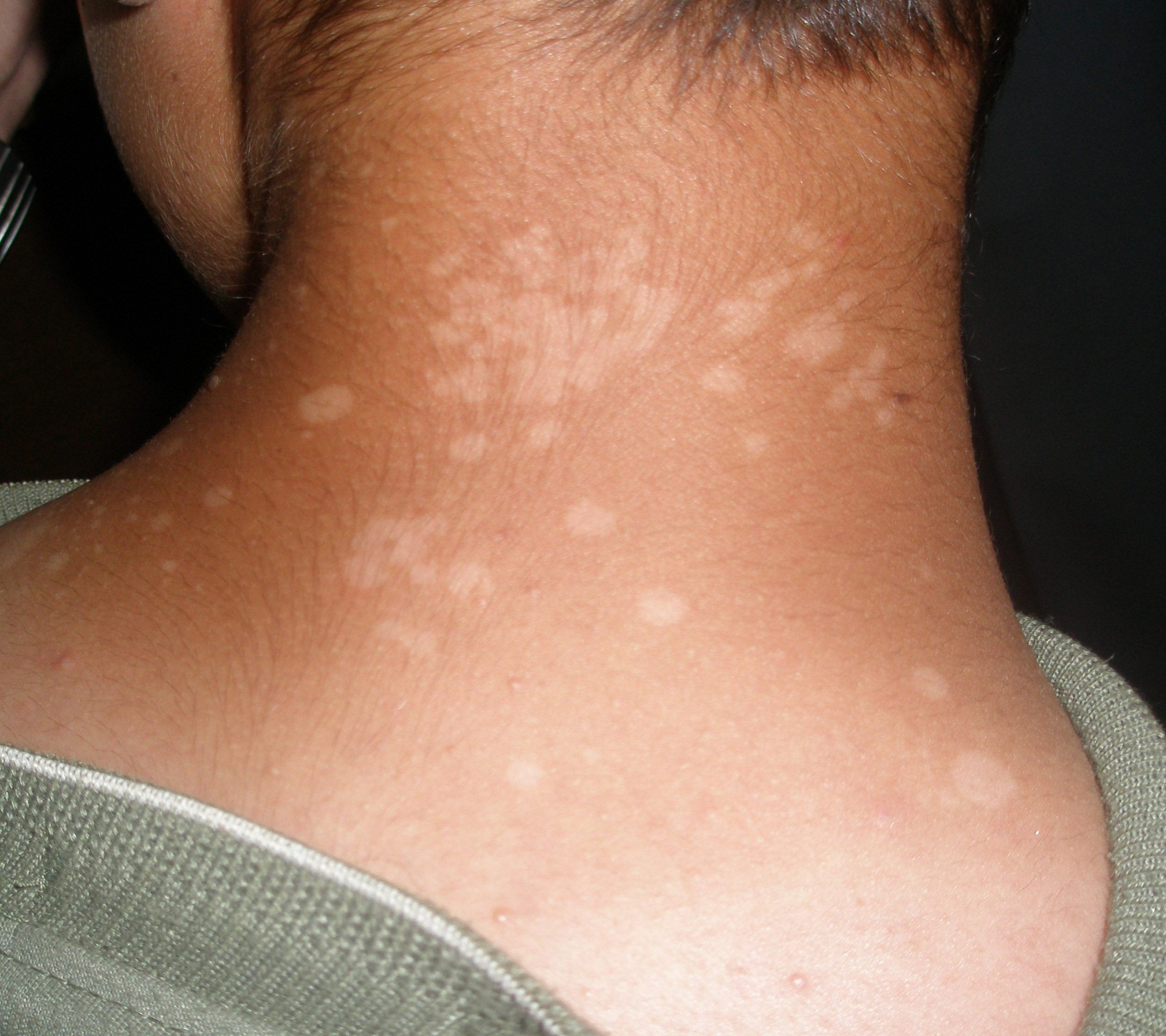 Tinea versicolor