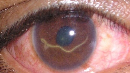 Toxocariasis | United States| PDF | PPT| Case Reports ...