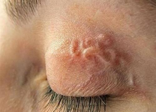 Bệnh sán chó (Toxocara) cực kỳ nguy hiểm 2 Bệnh sán chó (Toxocara)