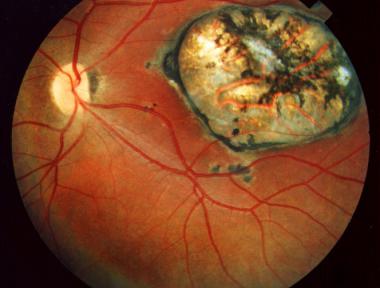 toxoplasmosis dogs toxoplasmosis united states pdf ppt reports symptoms treatment toxoplasmosis dogs toxoplasmosis united states pdf ppt reports symptoms treatment