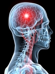 cure for transient global amnesia cure for transient global amnesia