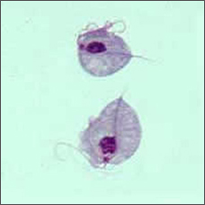 Trichomoniasis | Argentina| PDF | PPT| Case Reports | Symptoms ...