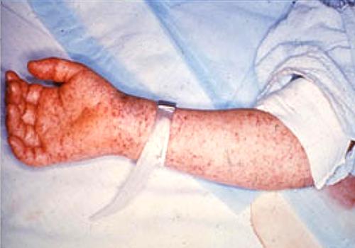 typhus fever